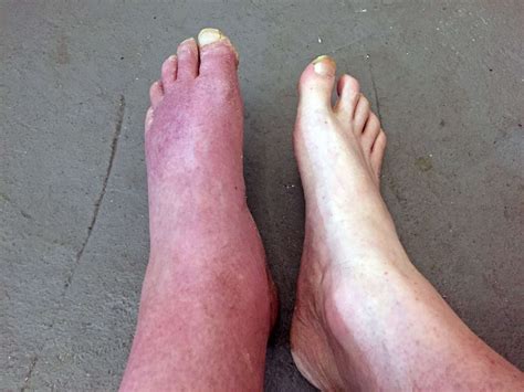 Erythromelalgia A Very Rare Condition