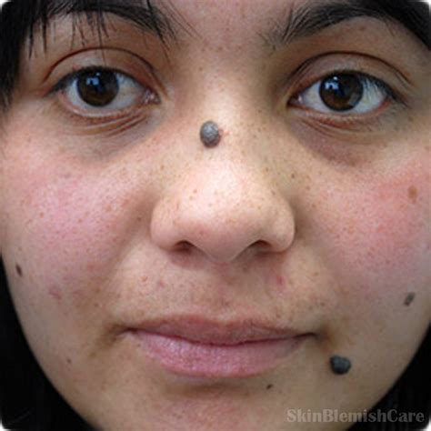 Face Mole Moles On Face Facial Mole Warts On Face