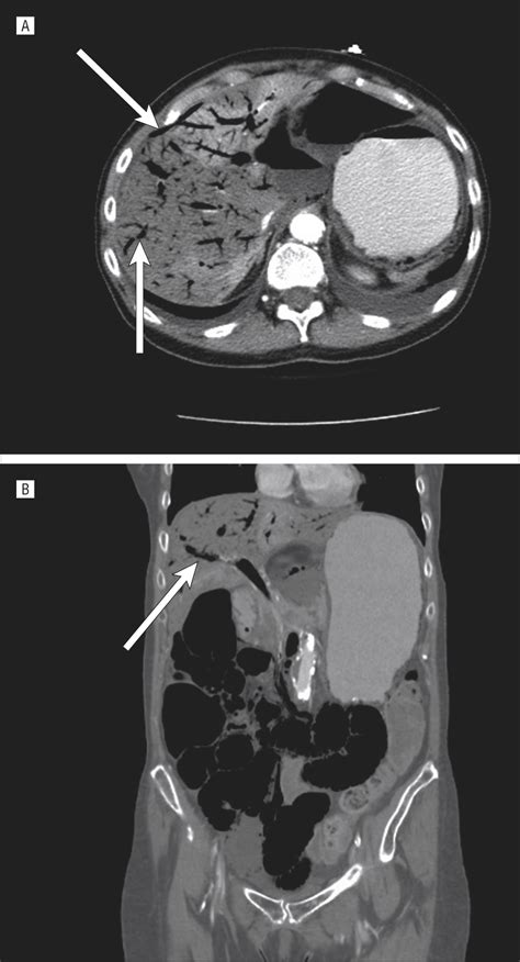 Hepatic Portal Venous Gas The Abcs Of Management Radiology Jama