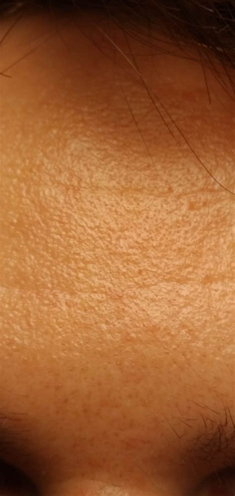 Skin Concerns Hello Maybe You Know What Causes This Skin Texture