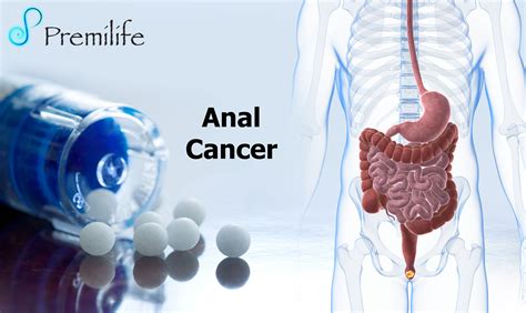 Anal Cancer Pictures