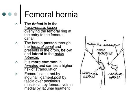 Inguinal Hernia Diagram Photos Cantik
