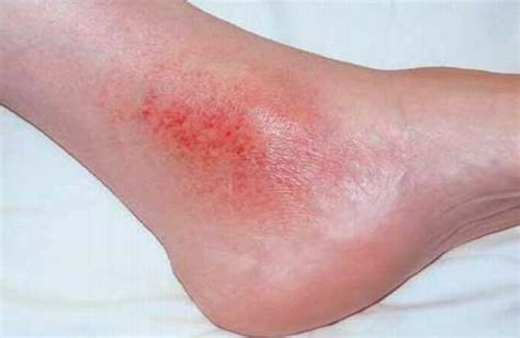 Stasis Dermatitis Eczema On Legs Causes And Treatment