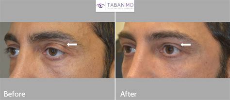 Eyelid Filler Injection Before And After Gallery Taban Md