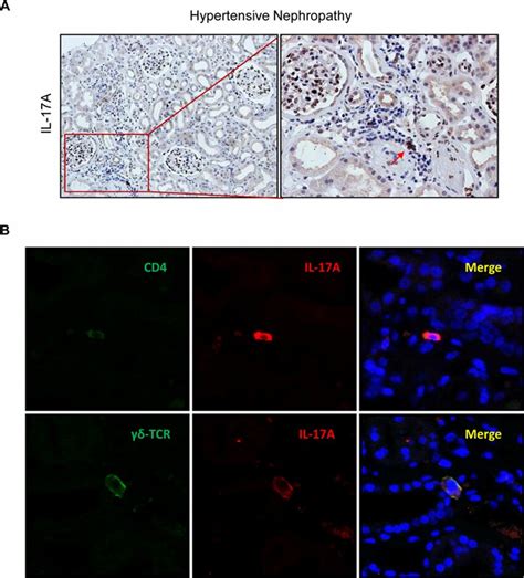 Il 17a Expressing Cells In Human Hypertensive Nephropathy A Il 17a