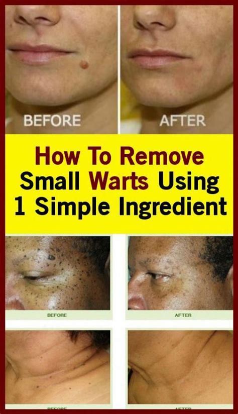 Pin On How To Remove Warts Naturally