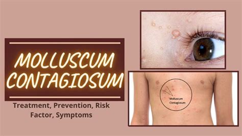 Molluscum Contagiosum And Its Treatment All You Need To Know Fashion