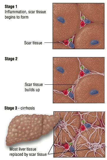 For some people, hepatitis b infection becomes chronic, meaning it lasts more than six months. Chronic Hepatitis Guide: Causes, Symptoms and Treatment ...