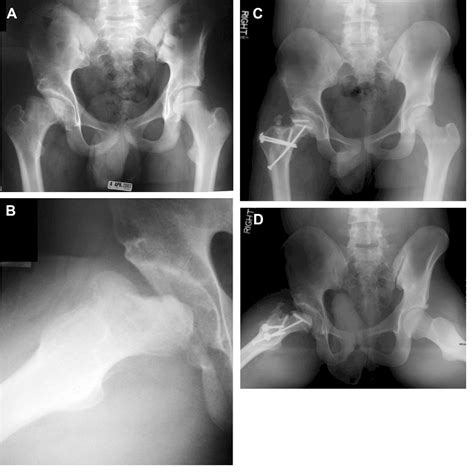 Figure 3 From The Treatment Of Femoral Head Deformity And Coxa Magna By