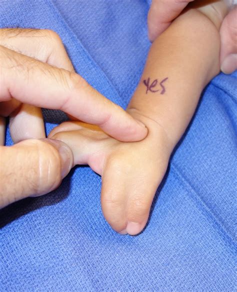 Thumb Index Syndactyly Congenital Hand And Arm Differences