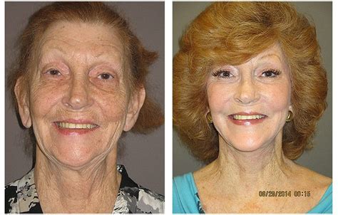 Facelift Disasters Why They Happen And How To Avoid One Lookyounger