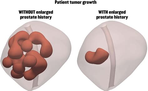 Enlarged Prostate Could Actually Be Stopping Tumor Growth Simulations Show Purdue University News