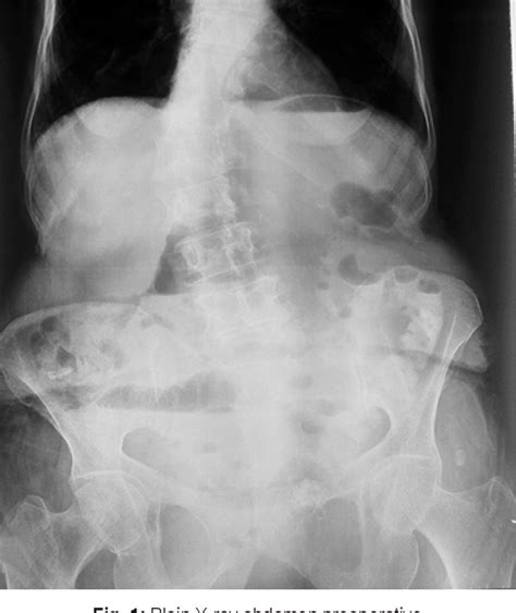 Figure 1 From Tapp Repair Of An Obstructed Obturator Hernia Semantic