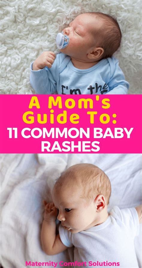 A Moms Guide To 11 Common Baby Rashes Baby Rash Newborn Rash Baby