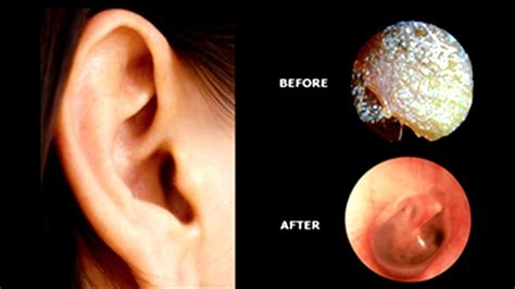 Tinnitus After Ear Wax Removal Tinnitus Choices