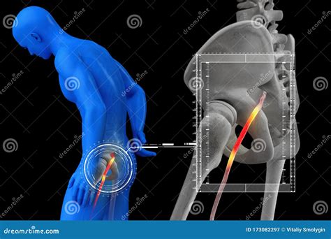 Sciatica Pinched Sciatic Nerve Causing Pain And Inflammation In Pelvis Vector Illustration