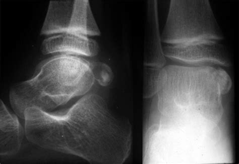 Lateral And Anteroposterior Radiograph Of The Right Ankle Showing An