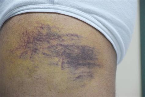Bruises On Dark Skin Symptoms And Treatment