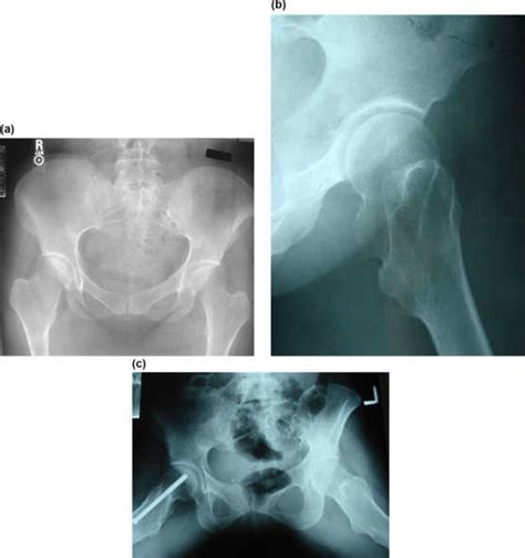 A 14 Year Old Girl Complained Of Posterior Thigh Pain At The Right