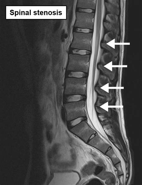 Lumbar Spinal Stenosis Physio Check