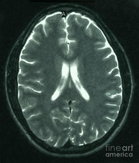 Mri Showing Normal Brain Photograph By Science Source Fine Art America
