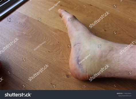 Swollen Ankle Bruise Stock Photo 1143223541 Shutterstock