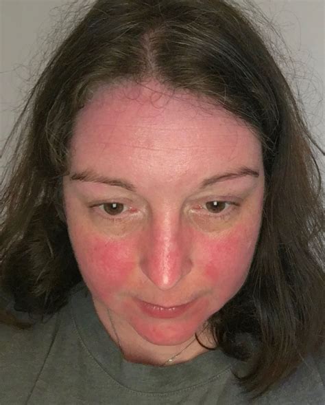 Malar Rash Red Butterfly Over The Bridge Appearance