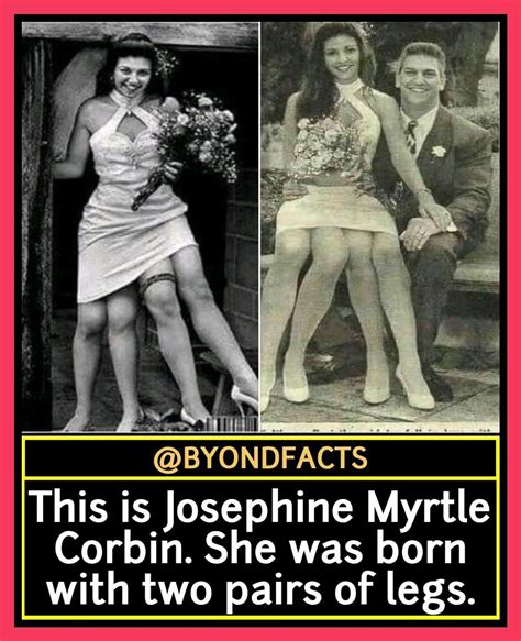 Myrtle Corbin Myrtle Corbin 18681927 Wasborn With A Dipygus Twin