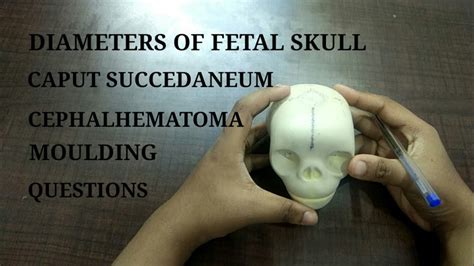 Fetal Skull Diameters Caputsuccedaneum Cephalhematoma Moulding And