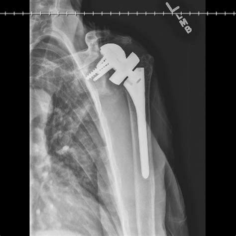 Anteroposterior Radiograph Showing Failed Reverse Shoulder Arthroplasty