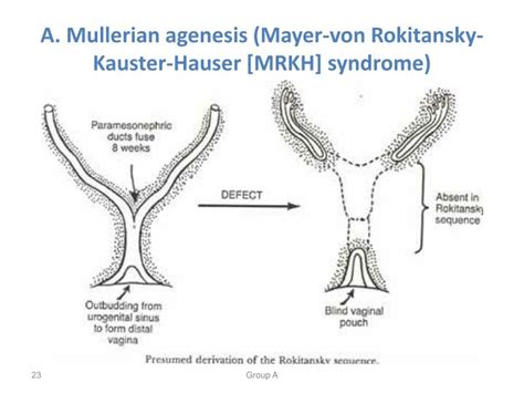 Mullerian agenesis, abbreviated as ma, is a disorder marked by congenital malformation. PPT - PEDIATRIC AND ADOLESCENCE GYNECOLOGY PowerPoint Presentation - ID:1317308