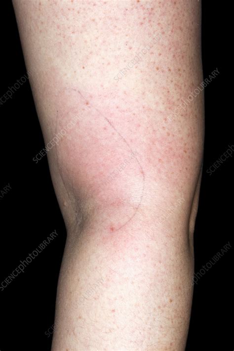 Phlebitis Stock Image C0581265 Science Photo Library