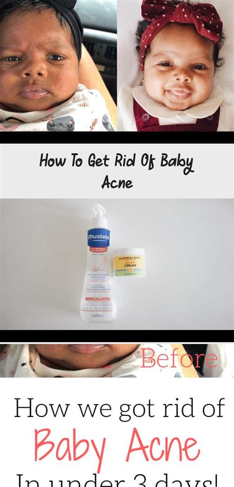 Pin By Wendy Moreno On Baby Baby Acne Acne How To Get Rid