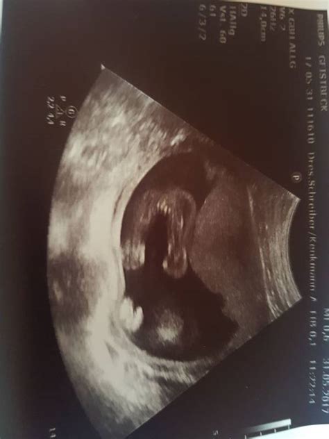 Check spelling or type a new query. Ultraschallbilder Baby Geschlecht - Test 6