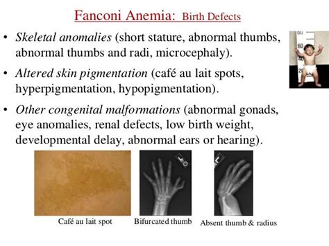 Bone Marrow Failure Syndromesppt