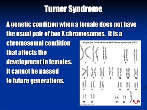 turner syndrome diagram