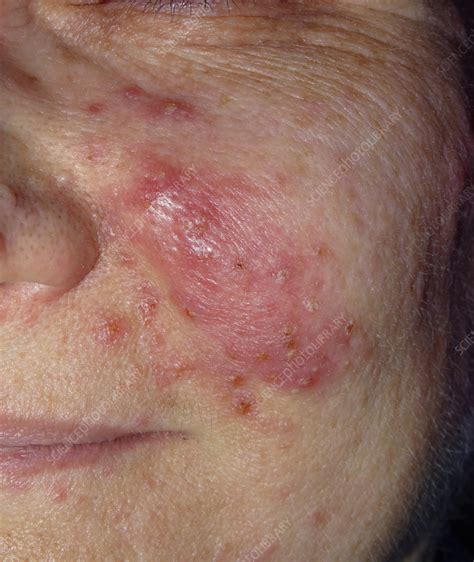 Acne Rosacea On A Womans Face Stock Image C0583197 Science