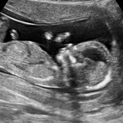 13 Weeks Pregnant Symptoms Ultrasound Belly Baby Development