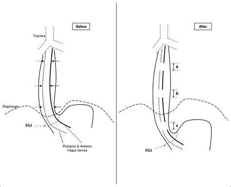 A Novel Technique For Gaining Extra Length Of The Abdominal Esophagus