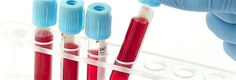 Lupus Monitoring Blood Test Developed By Exagen Diagnostics