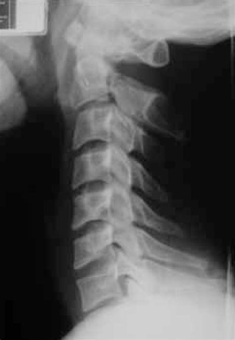 C2 Traumatic Spondylolisthesis Hangmans Fracture With Anterior And