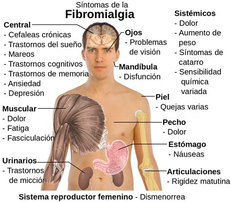 Maybe you would like to learn more about one of these? Ficheiro:Sintomas de la fibromialgia-es.svg - Wikipédia, a ...