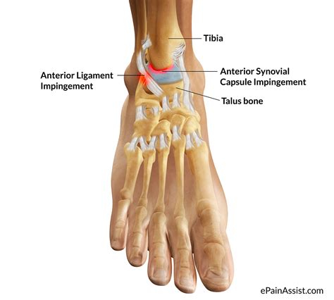 What Is Ankle Impingementsymptomscausestreatmentrecovery Period