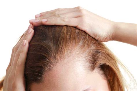What causes male hair loss? How to Deal With Hair Loss When You are a Woman? | Female ...