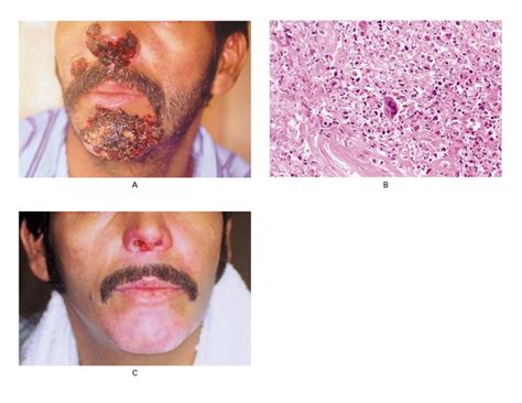 Severe Herpes Simplex Infection On An Hiv Patient Medihelp