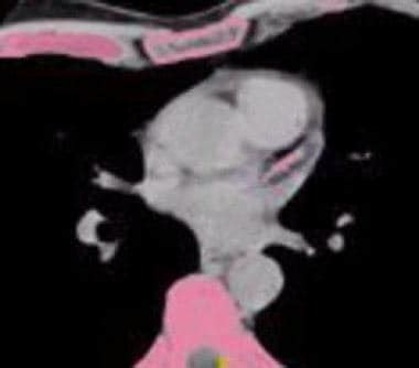 Coronary Artery Calcification On CT Scanning Practice Essentials Coronary Artery Calcium
