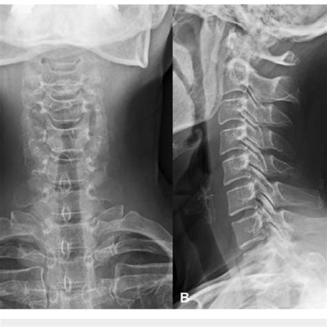 Computed Tomography Ct Scans Of The Cervical Spine At The One Month