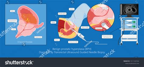 Transurethral Resection Prostate Stricture Urine Bladder Stock Vektorgrafik Lizenzfrei