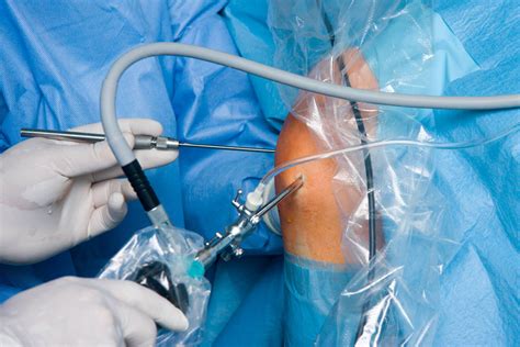 Knee Surgeon Fort Worth Knee Arthroscopy Dr Boothby Osmi