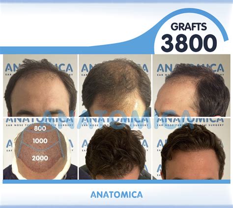 Haartransplantation Istanbul Türkei Anatomica Klinik